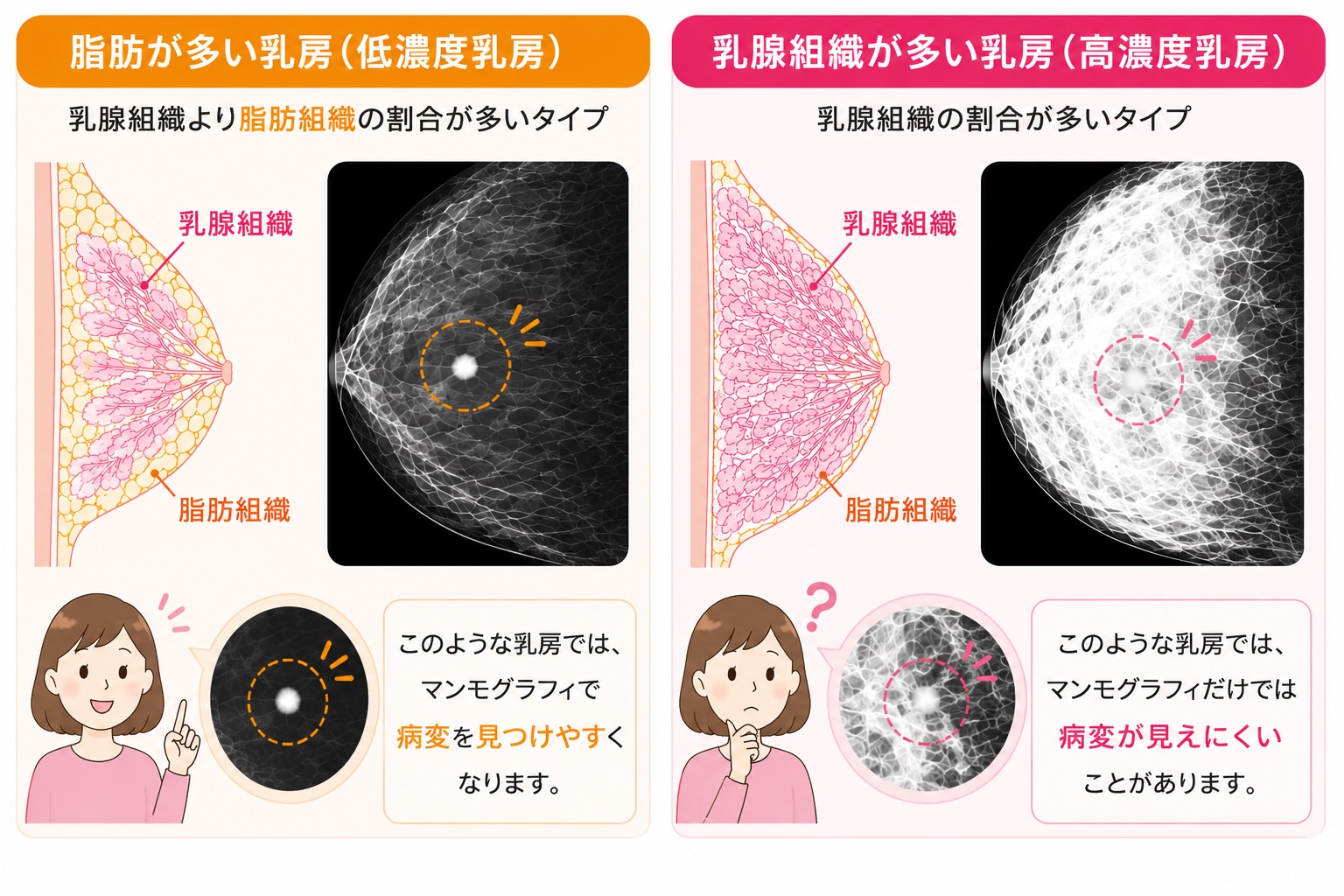 高濃度乳房ではマンモグラフィで病変が見えにくいことがあります