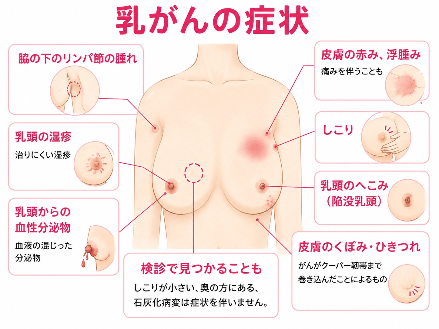 乳がんでみられる主な症状