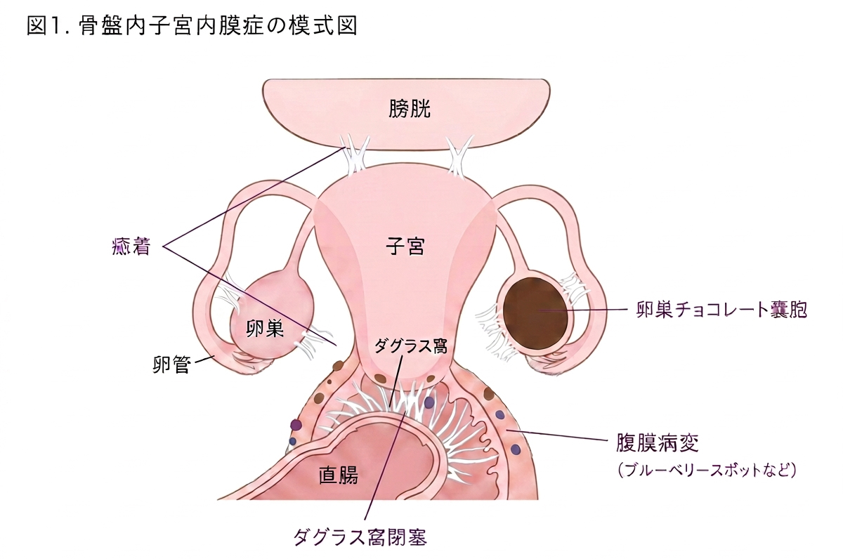 骨盤内子宮内膜症の模式図