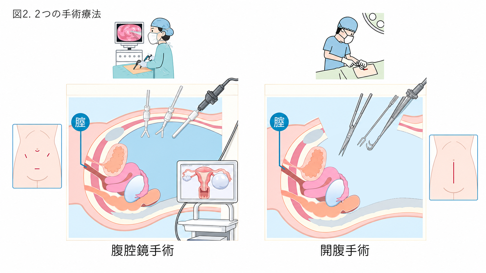 2つの手術療法