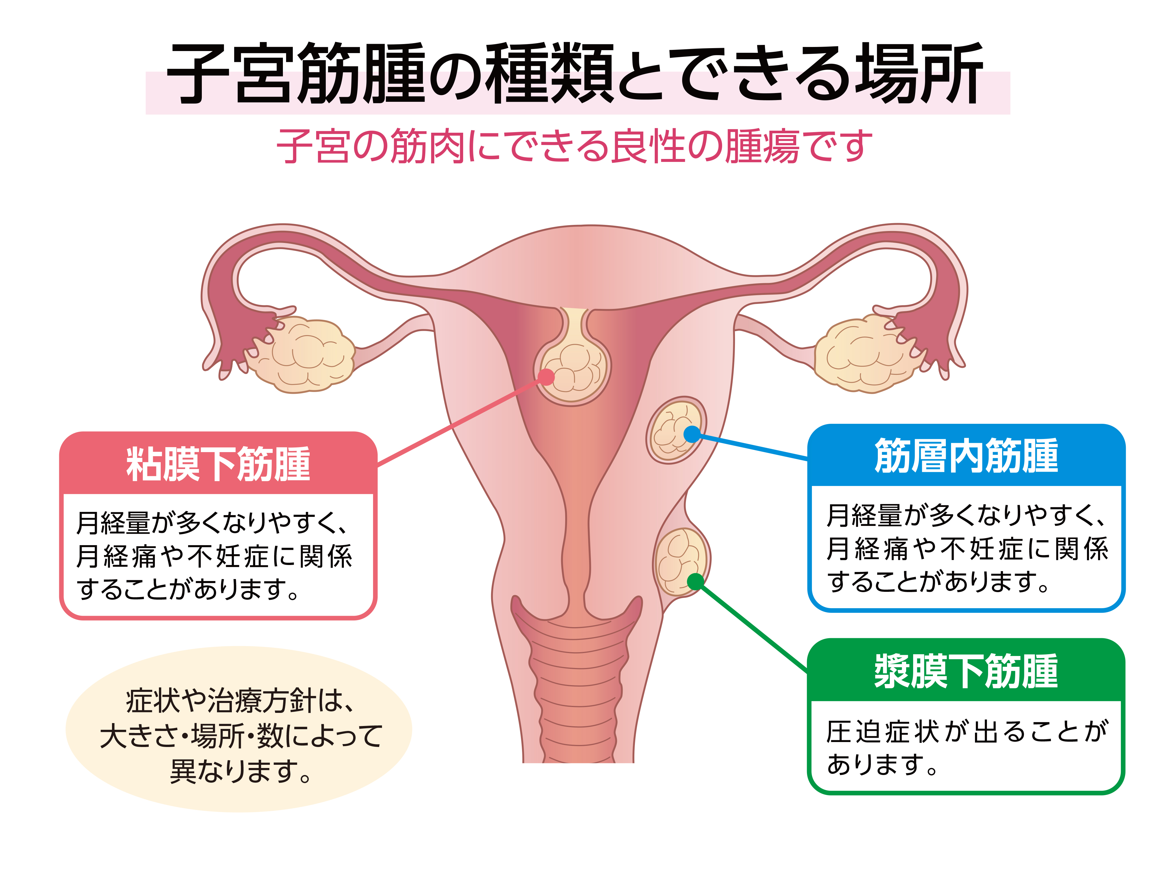 子宮筋腫の種類とできる場所